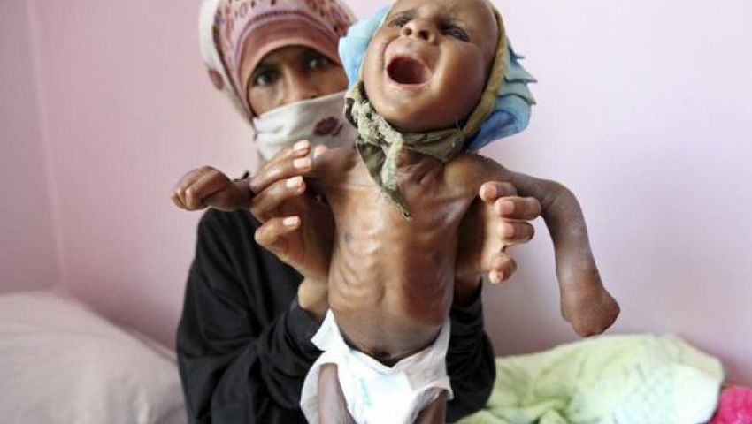 صورة في يوم العمل الإنساني.. سوء التغذية يلتهم أجساد اليمنيين
